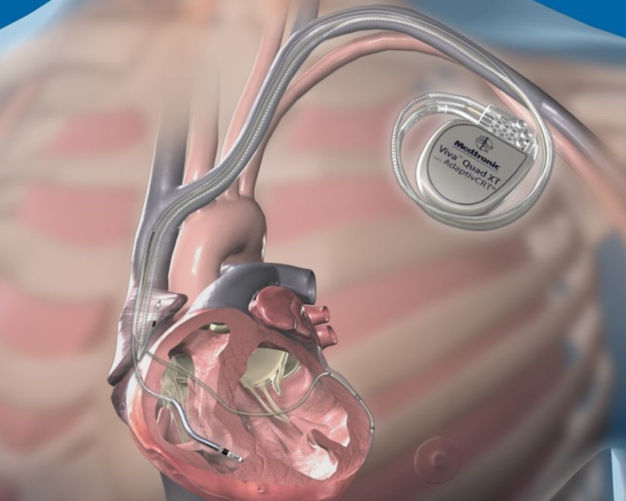 Dual Chamber Pacemaker and AICD device care
