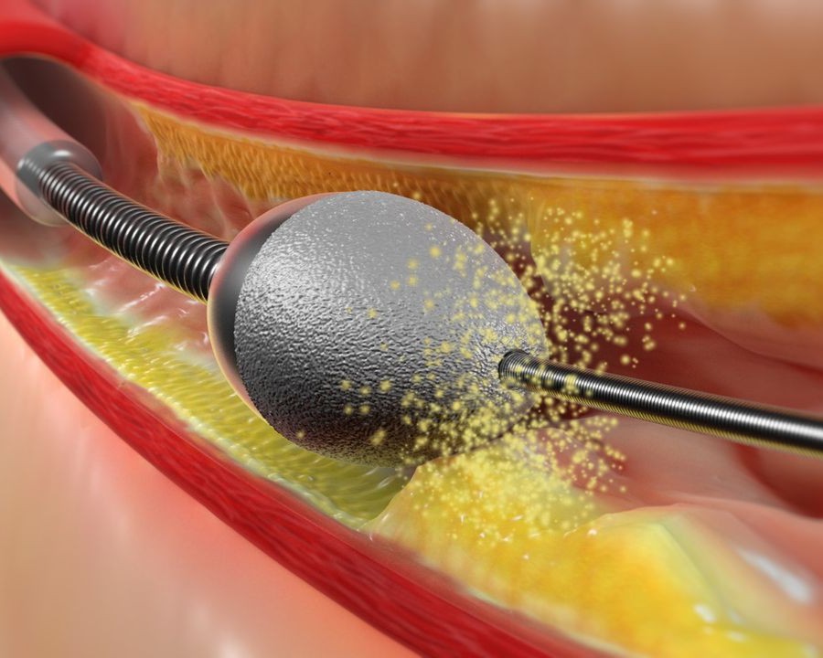 Rotational Atherectomy